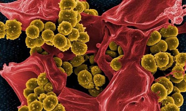 A Staphylococcus aureus a bakteriális prosztatagyulladás oka