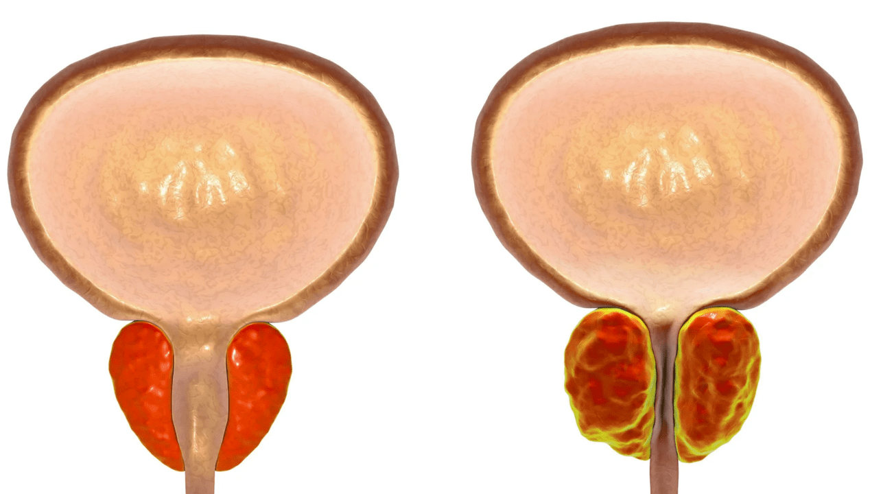 Mi a prosztatagyulladás