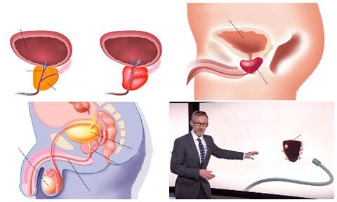 egészséges és beteg prosztata